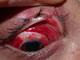 Sub-conjunctival haemorrhage and upper lid laceration