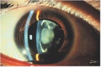 Example of a moderate cataract