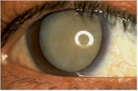 Example of a advanced cataract