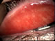 Mild conjunctival inflammation