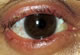 Inflamed swollen eyelids