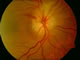 Swollen, infarcted optic nerve