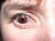 Same eye with occlusive cosmetic contact lens