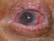 Upper eyelid entropion