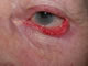 Pre operation - ectropion due to lower eyelid scarring