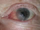 Pterygium