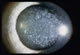 Granular corneal dystrophy