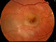 Haemorrhage and swelling of wet AMD