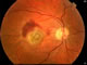 Haemorrhage and swelling of wet AMD