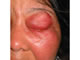 Cellulitis