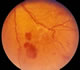 Prolferative retinopathy