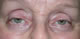 Pre-op ptosis