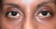 Post-op ptosis