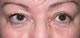 Post-op ptosis