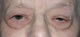 Pre-op ptosis